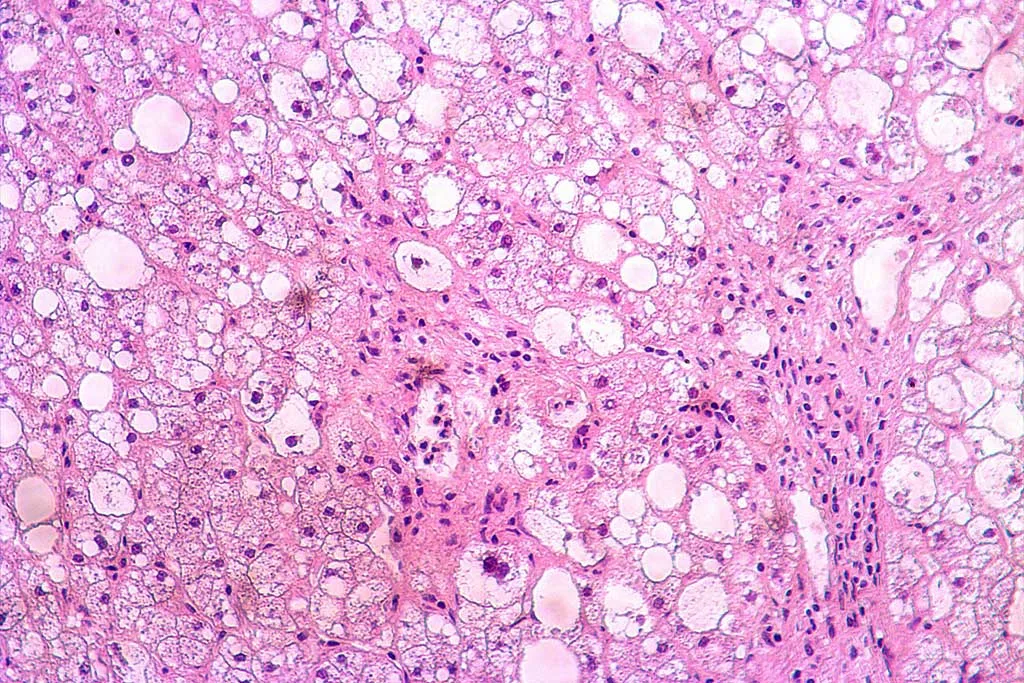 Liver-Disease-Models-1024×683 In Vitro MASLD and MASH Models: Selecting Primary Human Liver Cells for Metabolic Disease Research
